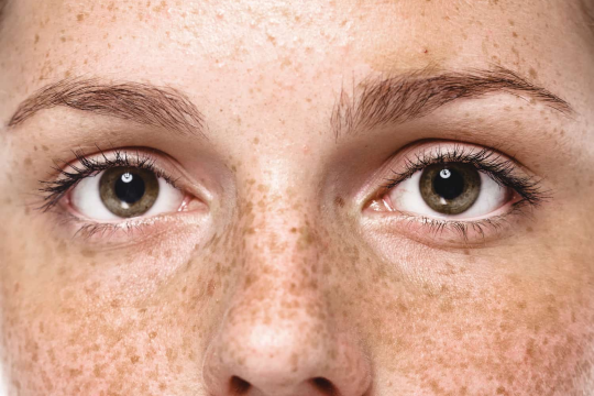 Tàn nhang là gì? Những thông tin chưa từng bật mí về tàn nhang