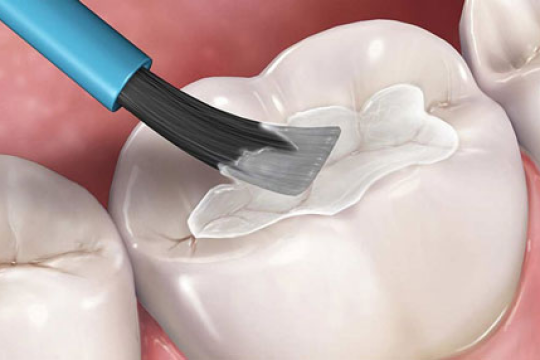 Trám răng là gì? Trám răng có gây ảnh hưởng đến sức khỏe hay không?