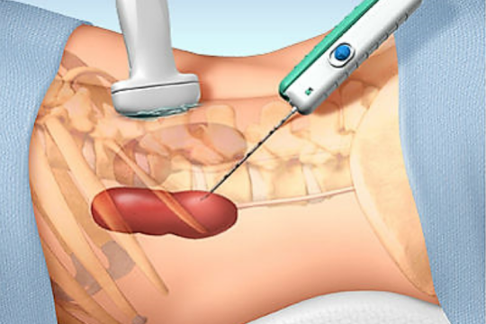 Sinh thiết là gì? Có rủi ro sau khi xét nghiệm sinh thiết không?