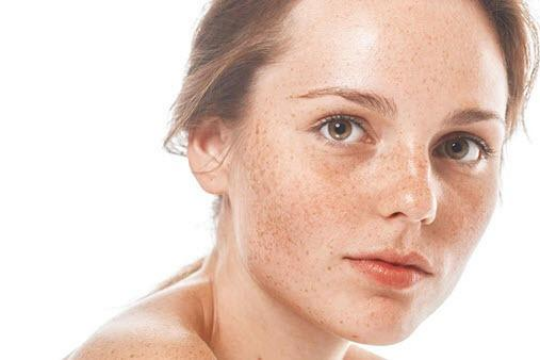 Review top 5 loại kem trị tàn nhang giúp cải thiện cho làn da của bạn