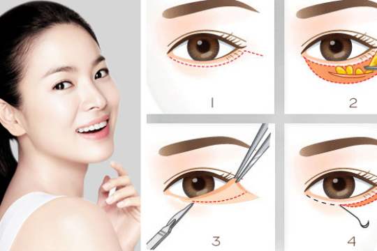 Review top 5 địa chỉ bác sĩ lấy bọng mắt giỏi tại TPHCM