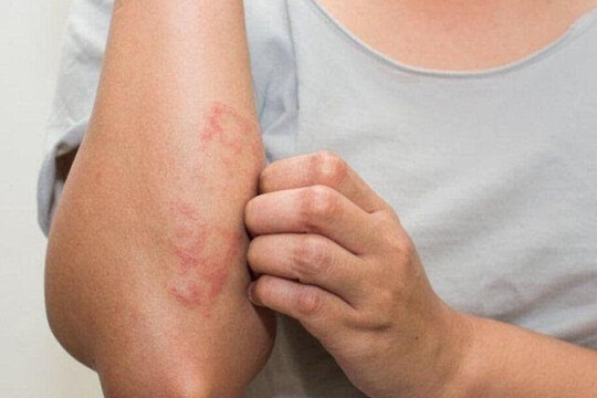 Vảy nến là gì? Triệu chứng và cách điều trị bệnh vảy nến