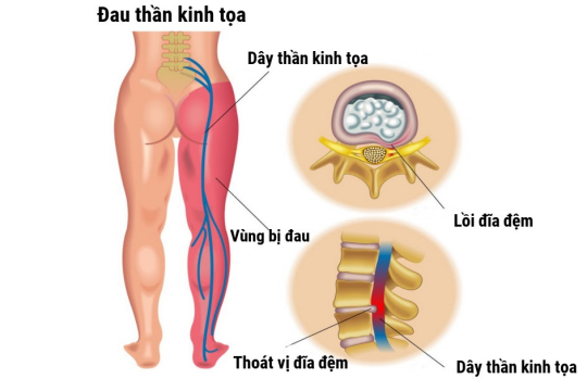 Đau thần kinh tọa là gì? Cần làm gì để hạn chế đau thần kinh tọa?